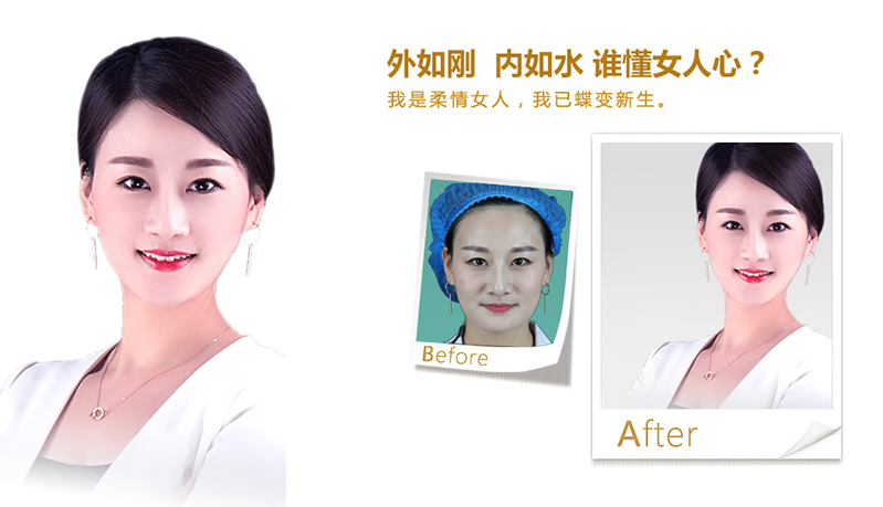 张家口V脸、线雕隆鼻